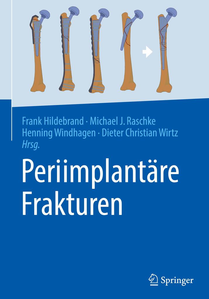 Produktbild: Periimplantäre Frakturen